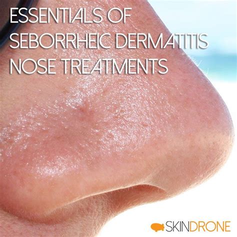Essentials Of Seborrheic Dermatitis Nose Treatments Cover Art