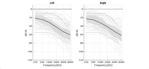 Audiograms Of The 75 Participants Of The Study Together With The