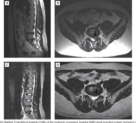 Figure 1 From Spontaneous Regression Of Lumbar Herniated Disc