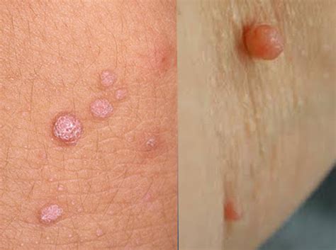 Unlike skin tags, warts are contagious. Wart & Skin Tag Removal In Bangalore | Dr.Joshy's Medical ...