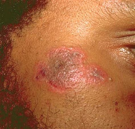 Discoid Lupus Erythematosus Pictures