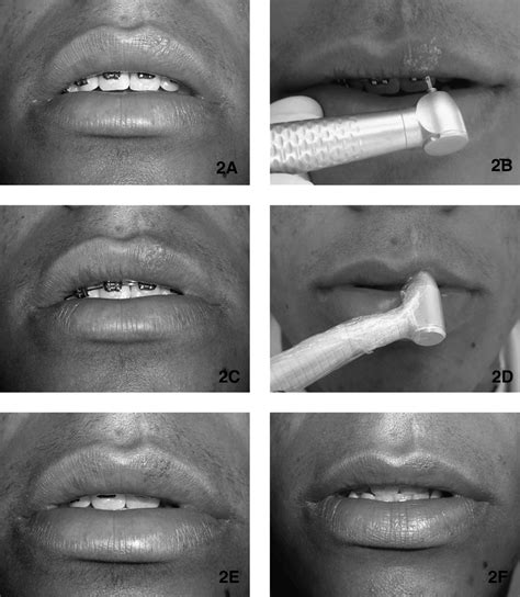 Initial Aspect Of Rhl On The Upper Lip A Drainage Of Vesicles With