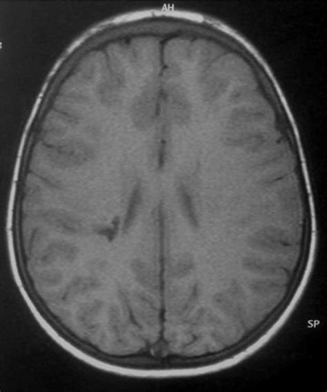 Axial Spin Echo T1 Magnetic Resonance Imaging Showing A Right