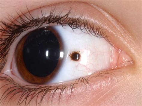Dark Spot On The Sclera Of Eye What Is It