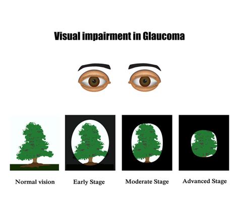 Glaucoma Risk Factors Symptoms And Treatment Davis Eyecare