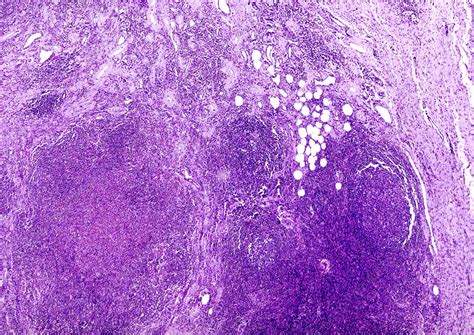 Human Eosinophilic Granuloma Light Micrograph Stock Image C049