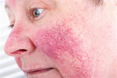 Psoriasis Versus Rosacea Differences Treatment And Other Conditions