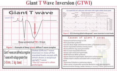 Giant Twave Inversion Diagnosis Cardiology Ekg Gtwi Grepmed