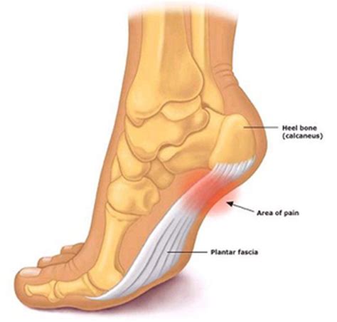 Plantar Fascitis Treatment In Victoria Bc Massage Therapy Rmt Victoria Bc Physiotherapy