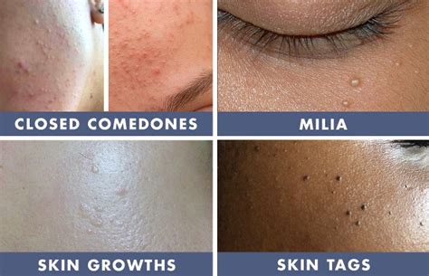 Bumps On The Skin — Age Bumps Skin Growths And Clogged Pores