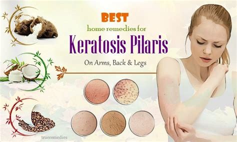 22 Best Home Remedies For Keratosis Pilaris On Arms Back And Legs