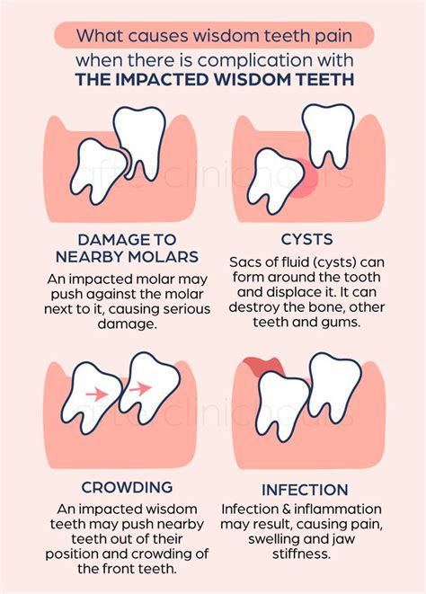 Wisdom Tooth Extraction Cost Procedure And Symptoms Riset