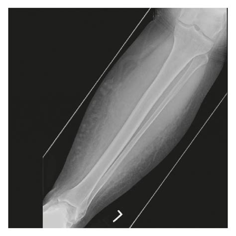 X Ray Of The Tibia Fibula A Antero Posterior Ap View B Lateral