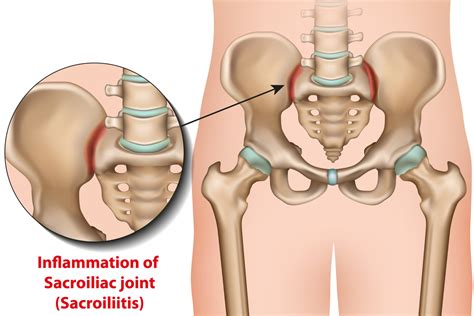 Sacroiliac Joint Dysfunction Causes Symptoms Treatment Advanced