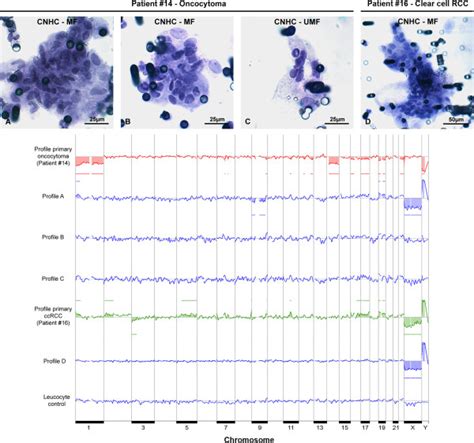 Array Cgh Profiles Of The Dna Of An Oncocytoma Or Clear Cell Rcc And