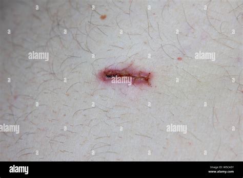 Infected Stitched Wound Knife Cut Stock Photo Alamy