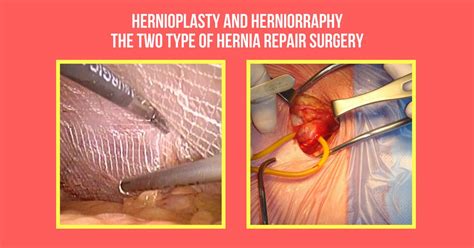 Hernia Surgery In Chennai Hernia Surgeon In Chennai Dr Maran