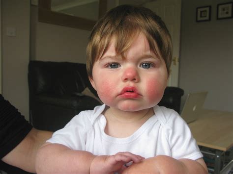 ‘slapped Cheek Syndrome A Common Rash In Kids More Sinister In