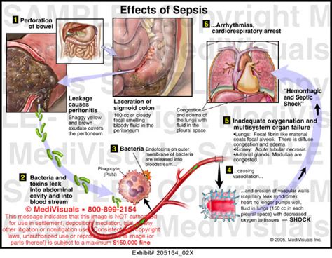 effects of sepsis medical illustration medivisuals