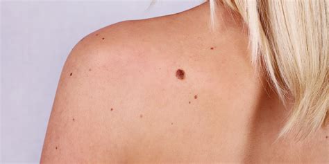 What Do Melanoma Spots Look Like My XXX Hot Girl