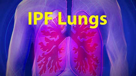 Researchers Continue To Study Idiopathic Pulmonary Fibrosis