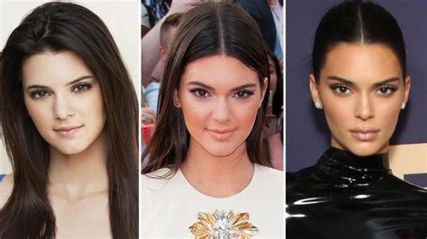 Kendall Jenner Plastic Surgery Before And After Photos