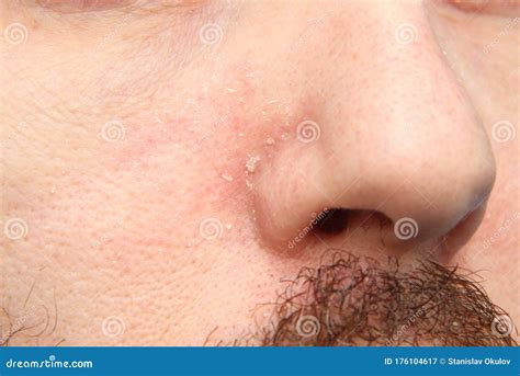 Part Of The Face With The Nose Of An Adult White Man With Dry Flaky