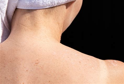 Home Remedies for Peeling Skin | Top 10 Home Remedies