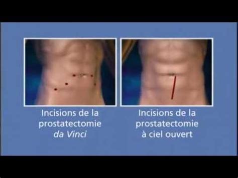 Chirurgie De La Prostate Faite Avec Le Robot Chirurgical Da Vinci