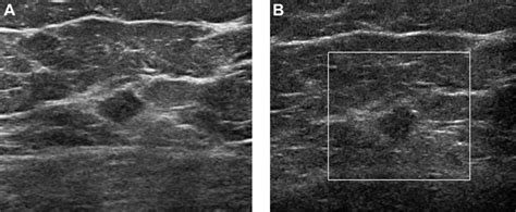 E Ultrasound Performed After Initial Screening Mammogram Demonstrates A