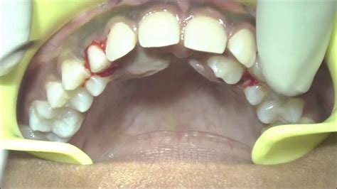 Extraction Of Retained Primary Maxillary Canines Youtube