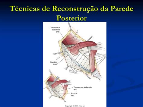 Nyhus is a true partner. PPT - Anatomia da Região Inguinal e Crural PowerPoint ...