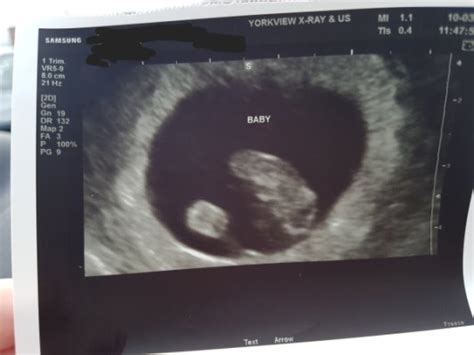 Ultrasound 8 Weeks 2 Days October 2018 Birth Club Babycenter Canada