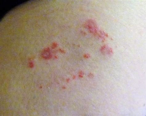 Inner Thigh Herpes Symptoms Causes And Treatment
