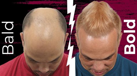 Unthinkable Transformation Through The Hair Transplant Procedure Youtube