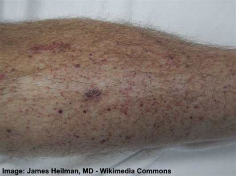 Petechiae Causes Symptoms And Treatments Including Images