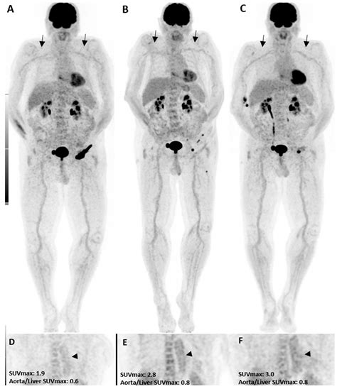 Diagnostics Free Full Text Impact Of 18f Fdg Petct In The