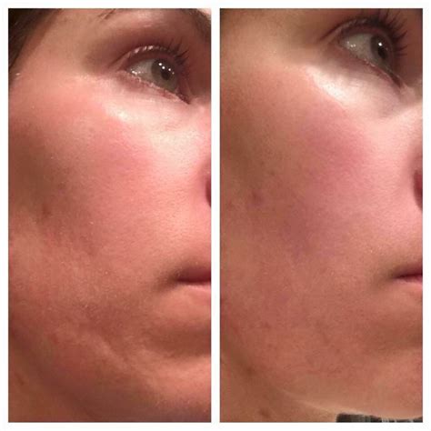 We Change Lives Before And After Of Acne Scarring Using Our Serum And