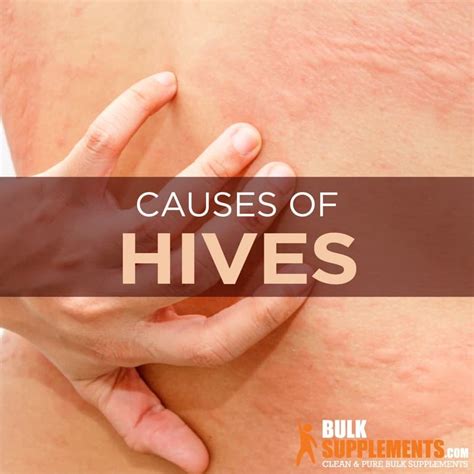Hives Symptoms Causes And Treatment