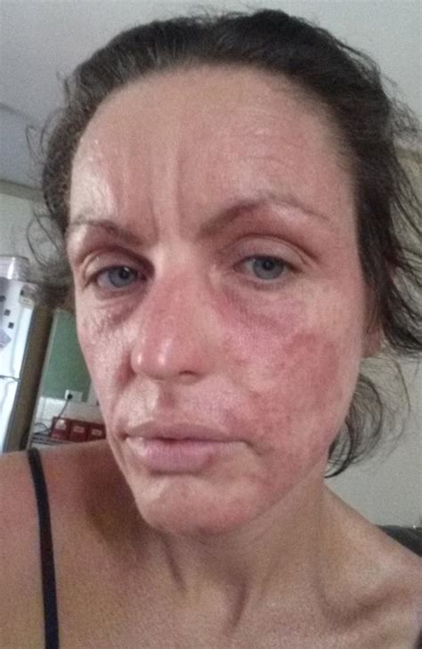 Eczema Treatment Woman Spends 50k Trying To Cure Severe Dermatitis