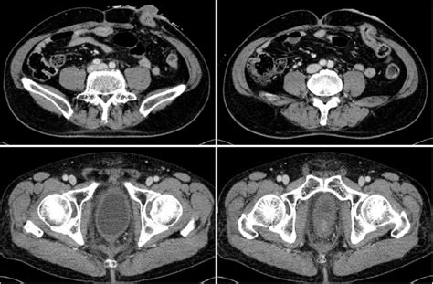 An Abdominal Pelvic Computed Tomography Ct Scan Shows The Colostomy