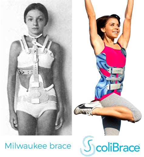 Scolibrace Scoliosis Clinic Uk Treating Scoliosis Without Surgery