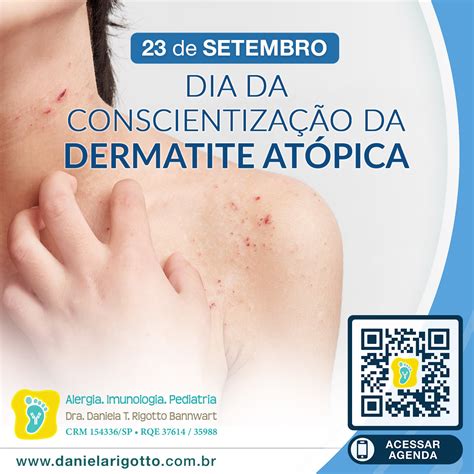 Dia Da Conscientização Da Dermatite Atópica Dra Daniela T Rigotto