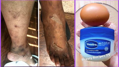 How To Remove Dark Spots Scar Fast Using Vaseline Best Remove