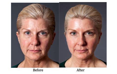Ipl Photofacial Before And After Skin Rejuvenation And