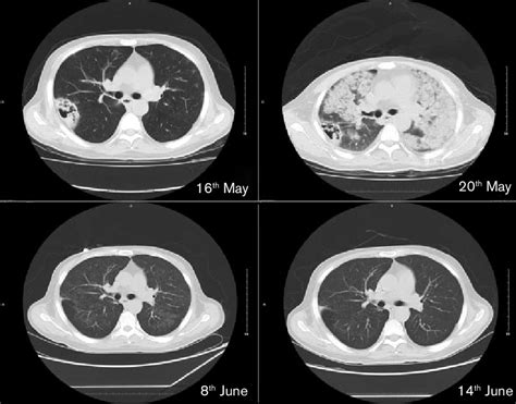 Chest Ct Scans Of Patient 1 The Date When The Patient Was Examined Is