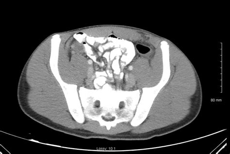 Ct Scan Demonstrating Left Sided Spigelian Hernia In This Patient
