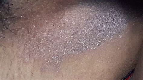 Tinea Cruris Female Treatment 47 Unconventional But Totally Awesome