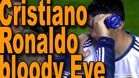 Cristiano Ronaldos Bloody Eye Injury Youtube