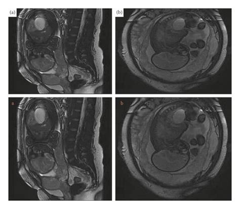 The Mri Image Of A Marginal Placenta Previa Case A The Sagittal